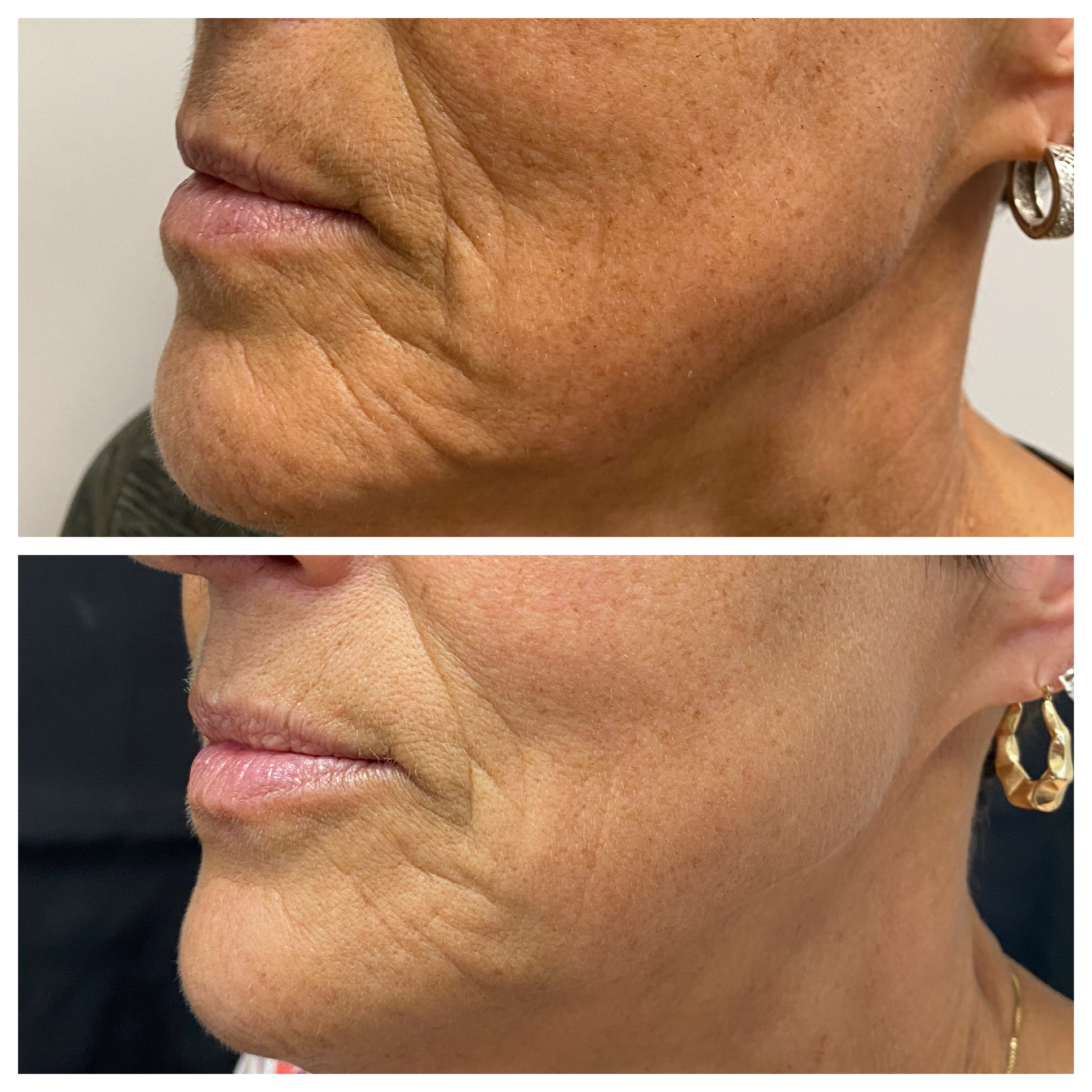 Side-profile before and after of the lower face and lips following a filler service.