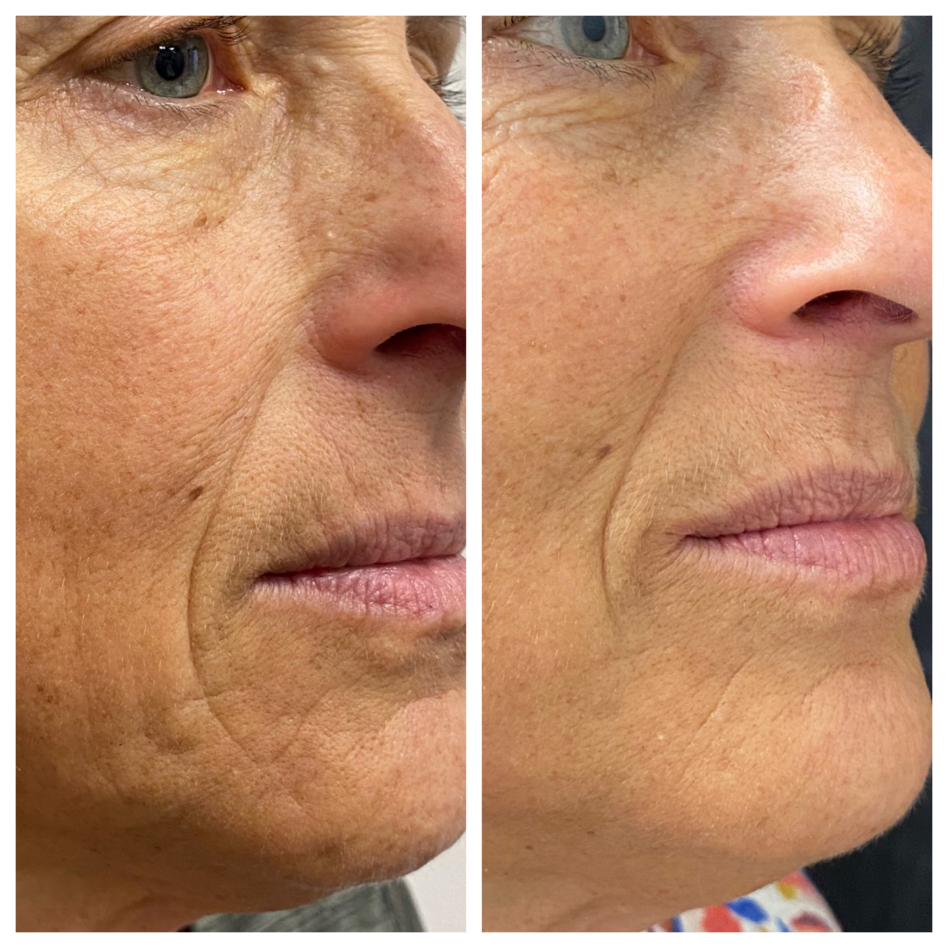 Provider administering a facial injectable to a client in a modern treatment room