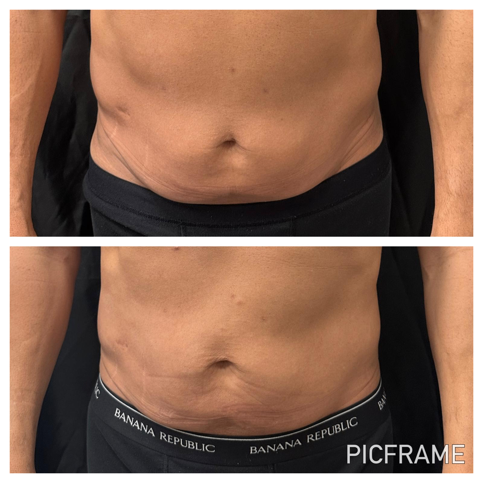 Before and after body sculpting: reduced abdominal fullness and smoother midsection contour