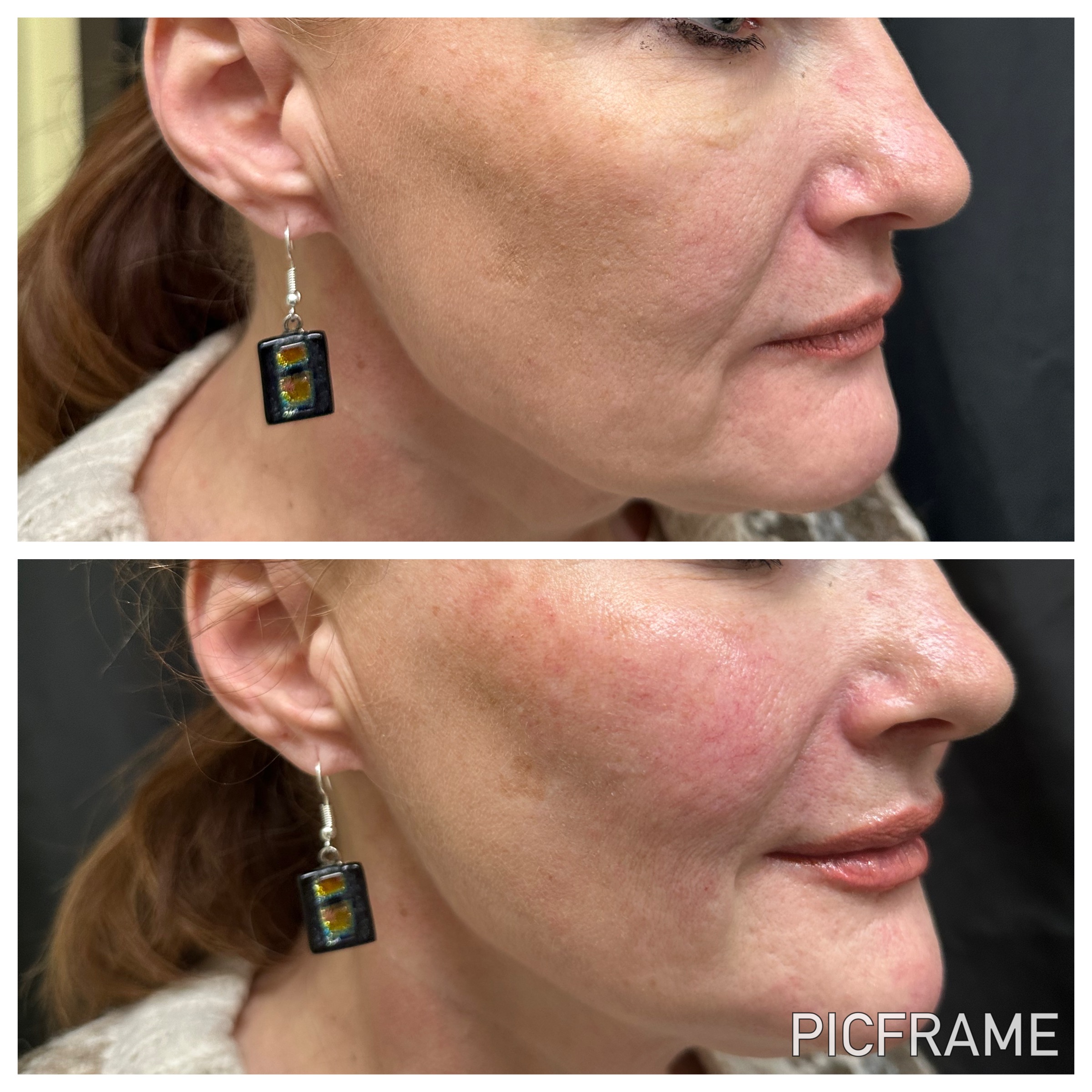 Stacked side-profile views of the cheek showing changes in skin tone and texture at Ridgeline Longevity & Aesthetics.