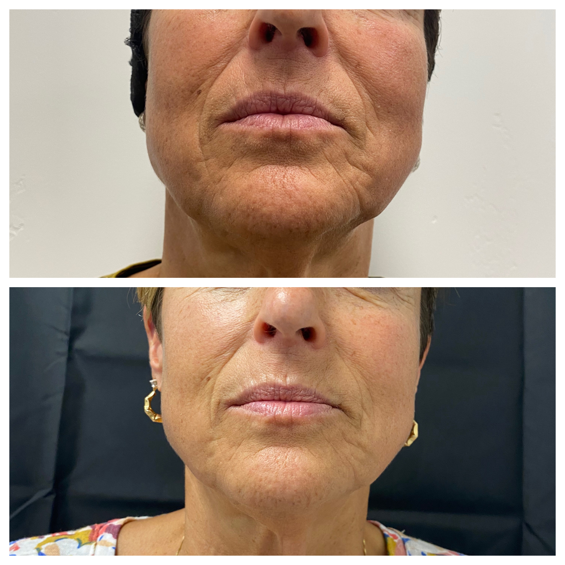 Before and after of lower face, jaw and neck skin firmness for a Ridgeline patient