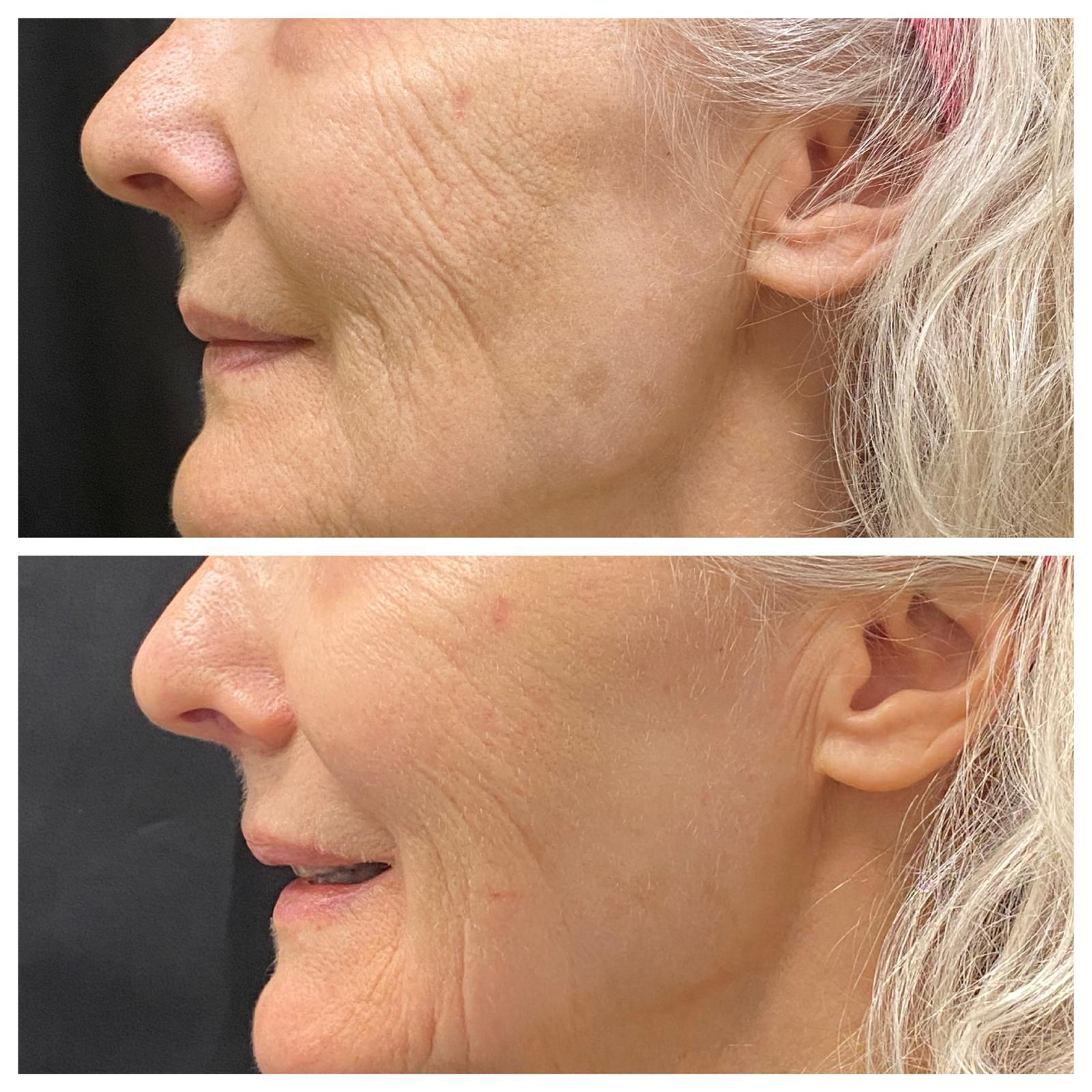 Stacked side-profile views of the lower face showing changes in skin smoothness and fold appearance at Ridgeline Longevity & Aesthetics.