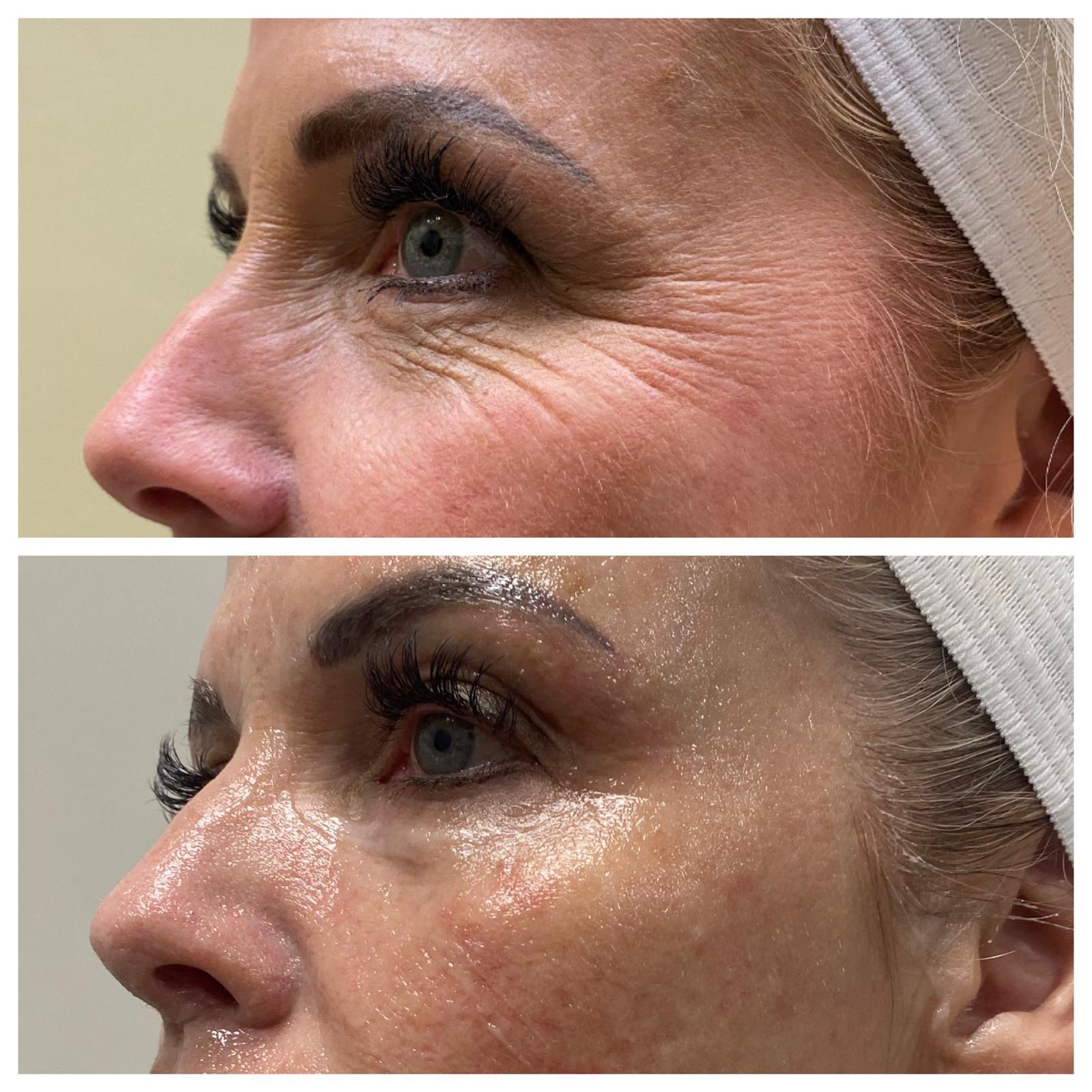 Crow's feet improvement around the eye area