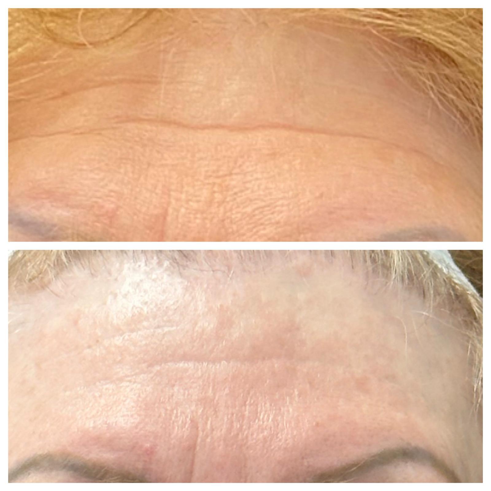 Forehead lines: before and after