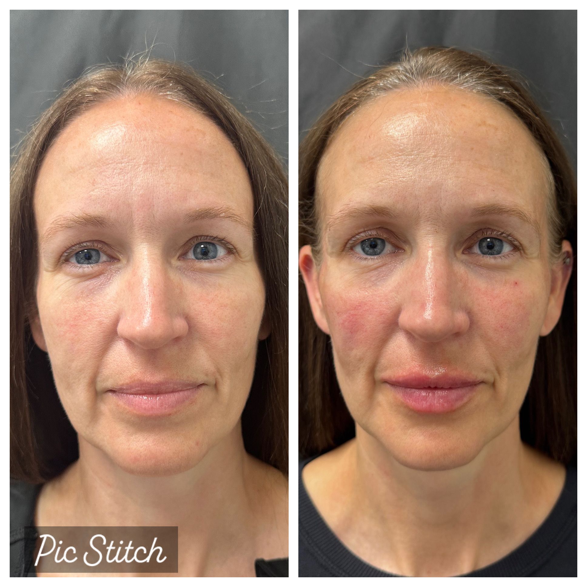 Facial balancing with filler