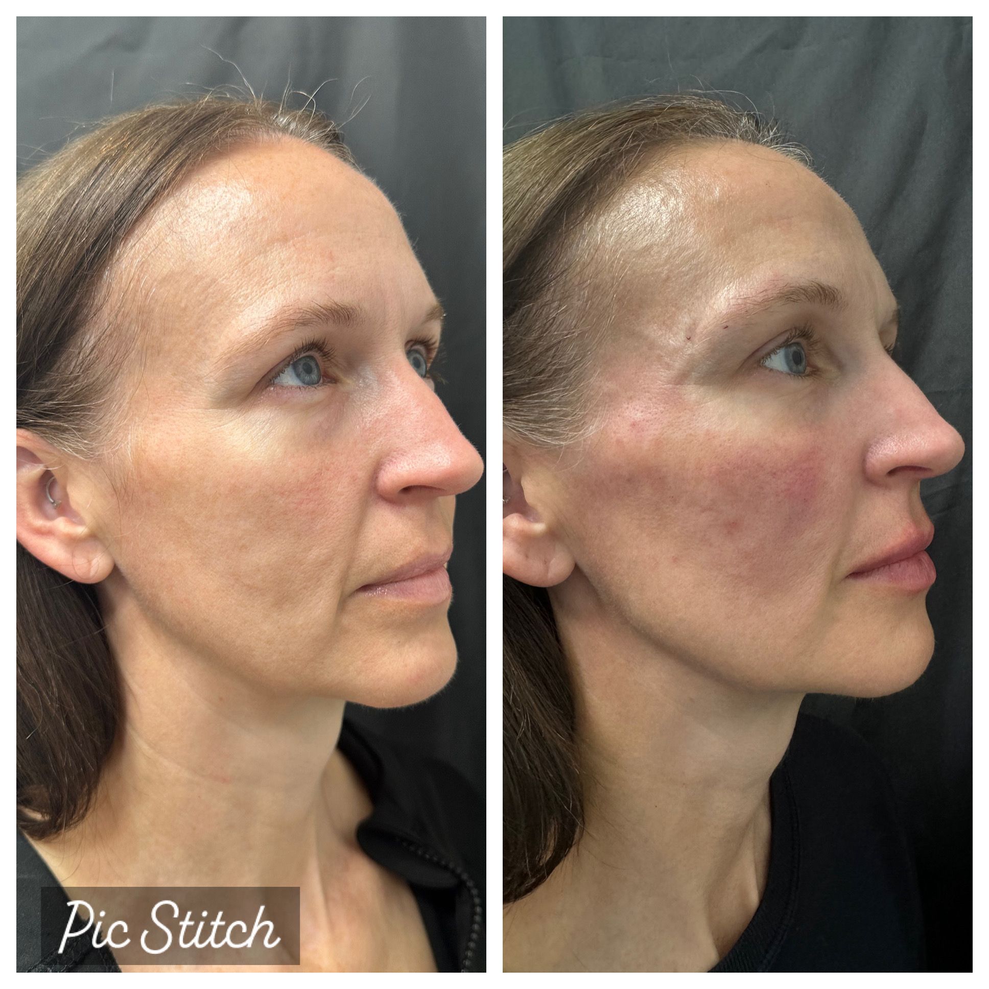 Before and after facial skin resurfacing treatment