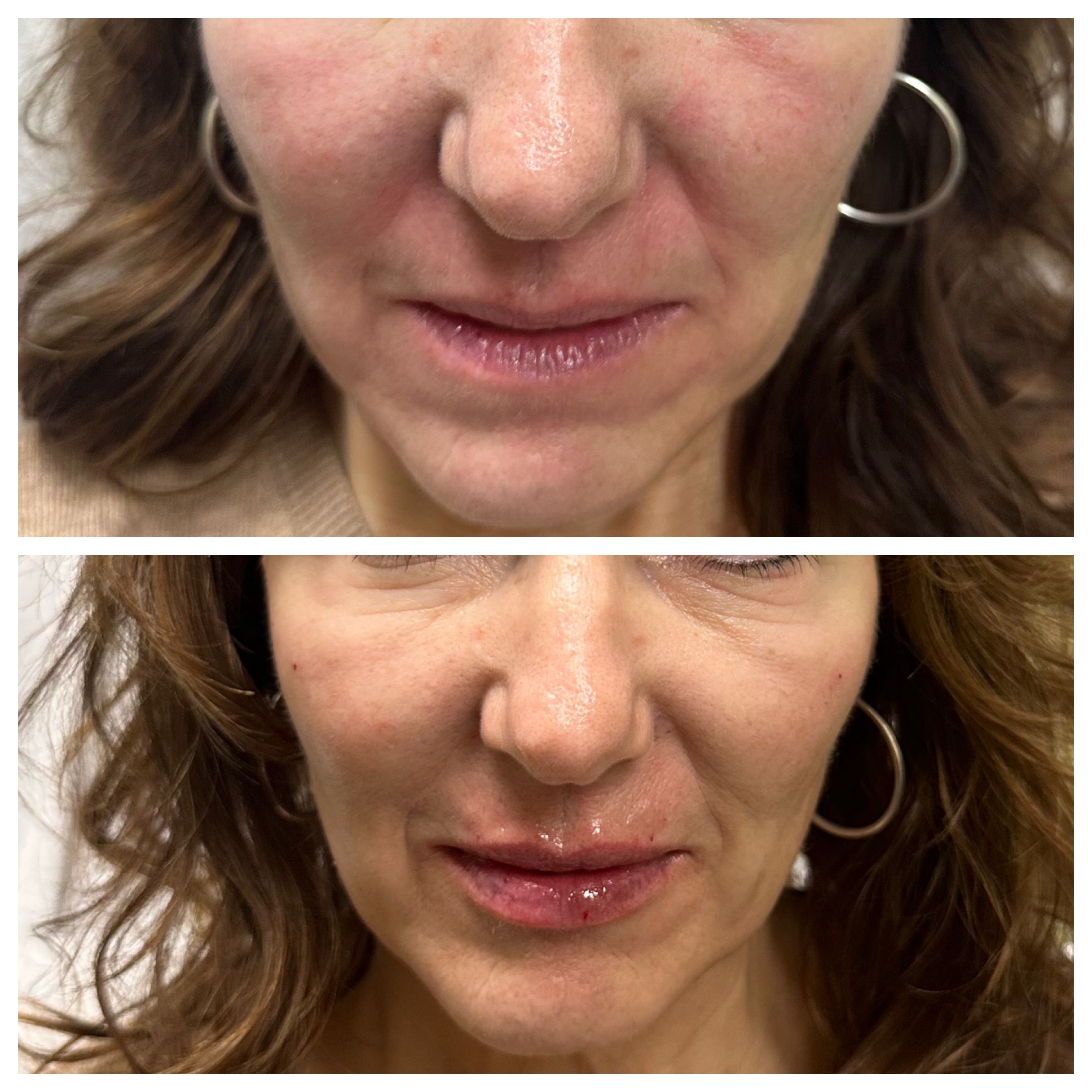 Lip filler results