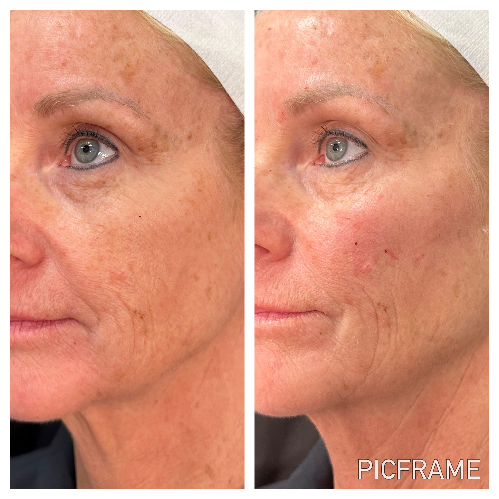 Softly refreshed, naturally balanced face after a personalized facial balancing plan at Ridgeline Longevity & Aesthetics.