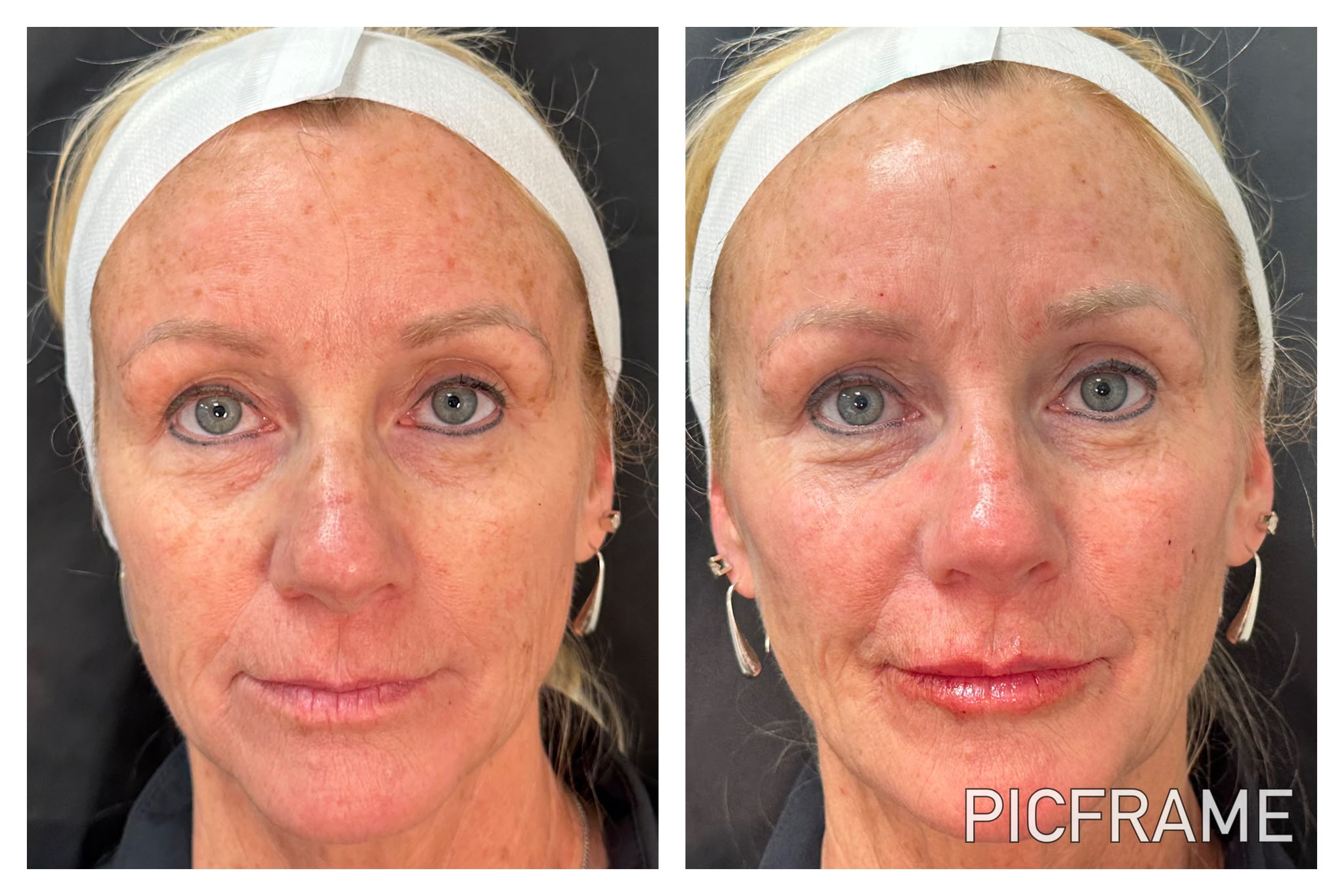 Skin texture and tone improvement after treatment