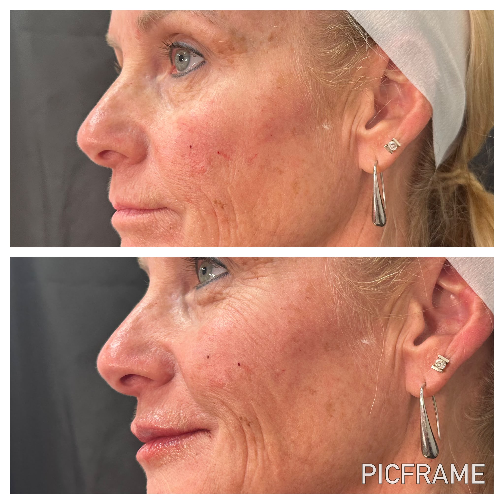 Before & after: improved skin tone and texture