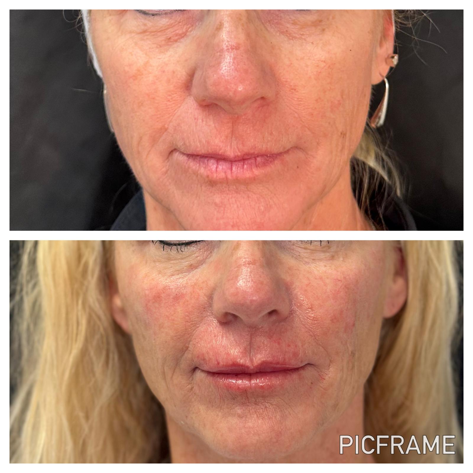 Lip filler results: enhanced lip fullness and smoother surrounding skin texture.