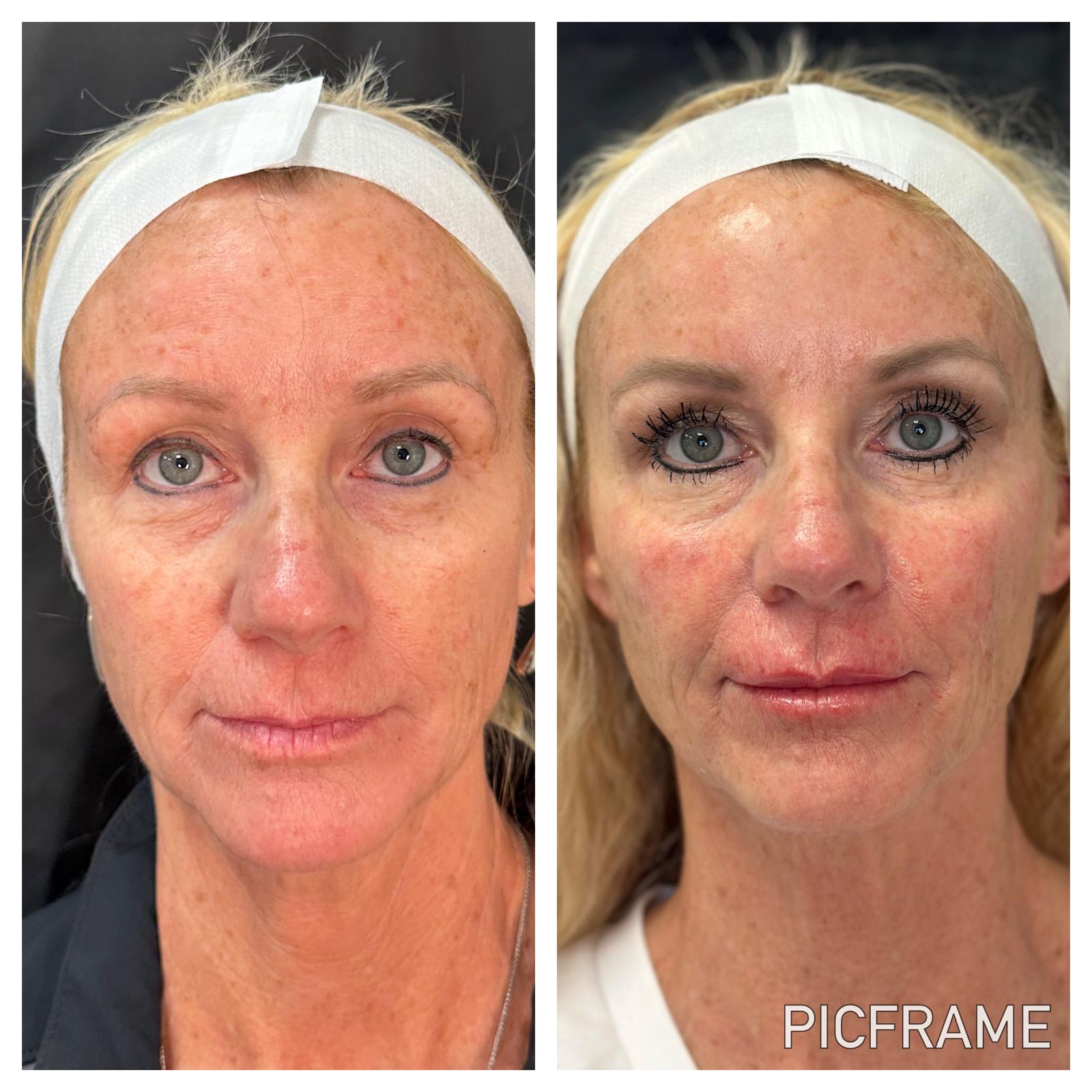 Before and after skin resurfacing treatment
