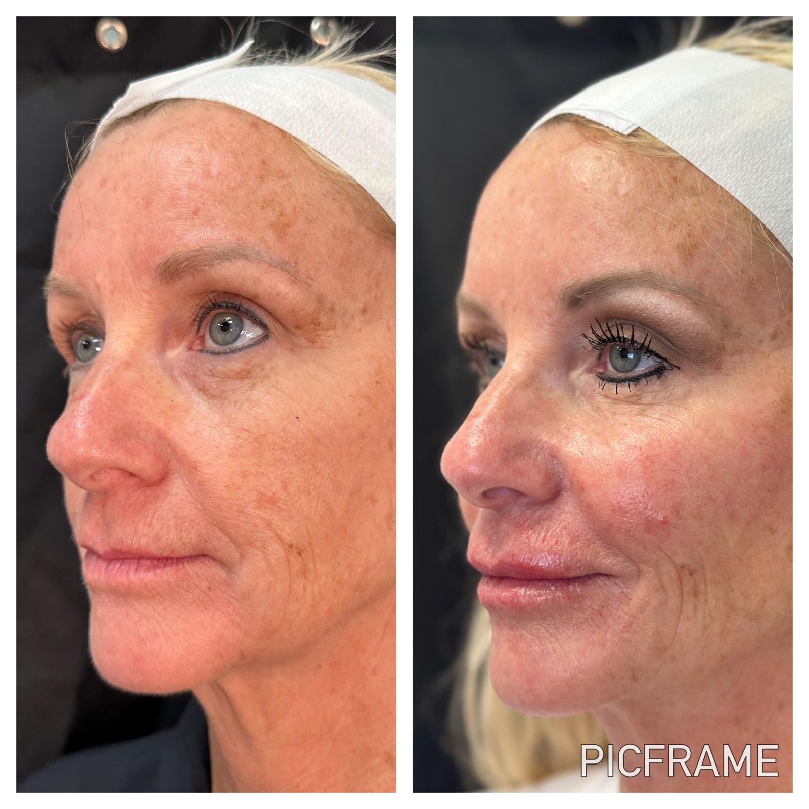 Before and after skin treatment results