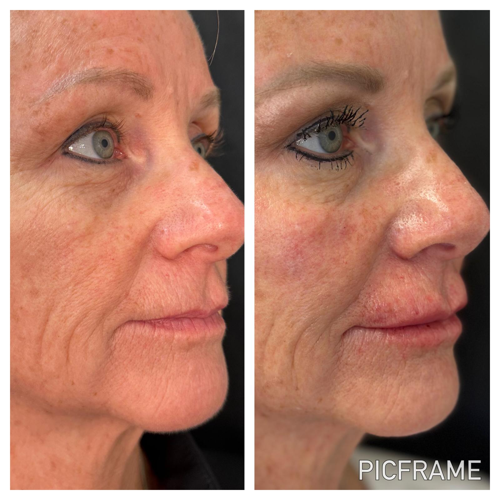 Facial skin texture improvement