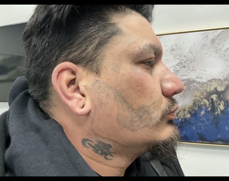 Tattoo Removal – Before