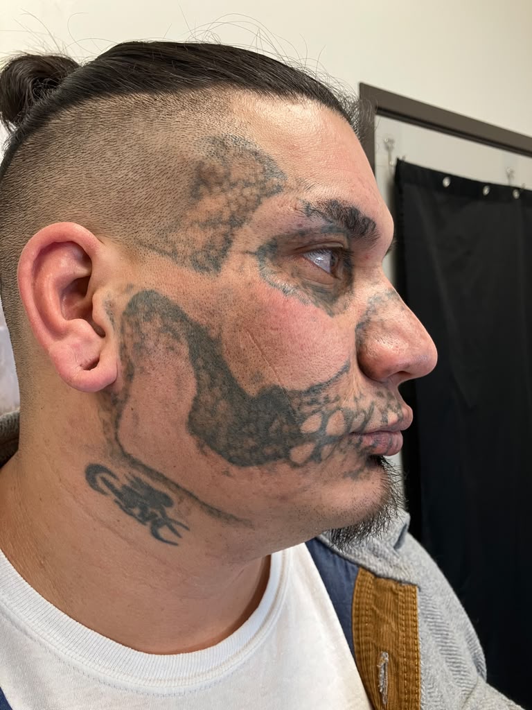 Facial tattoo prior to laser removal treatment.
