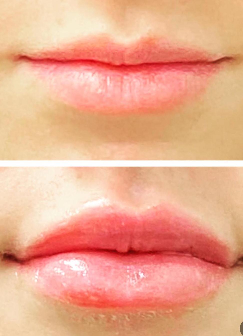 Lip Filler Results