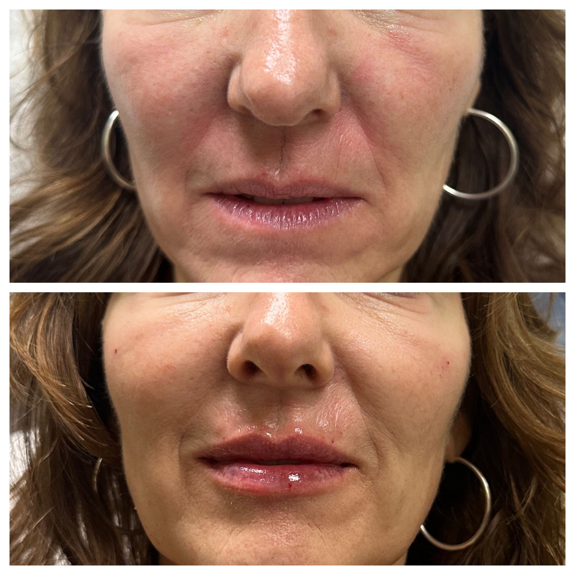 Lip filler results