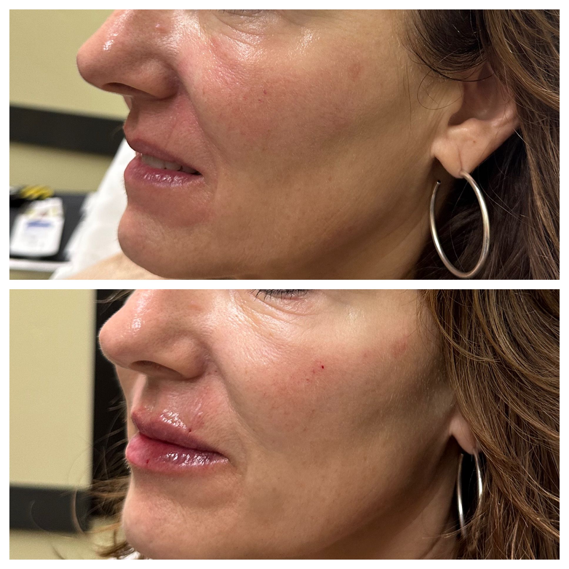 Lip filler results