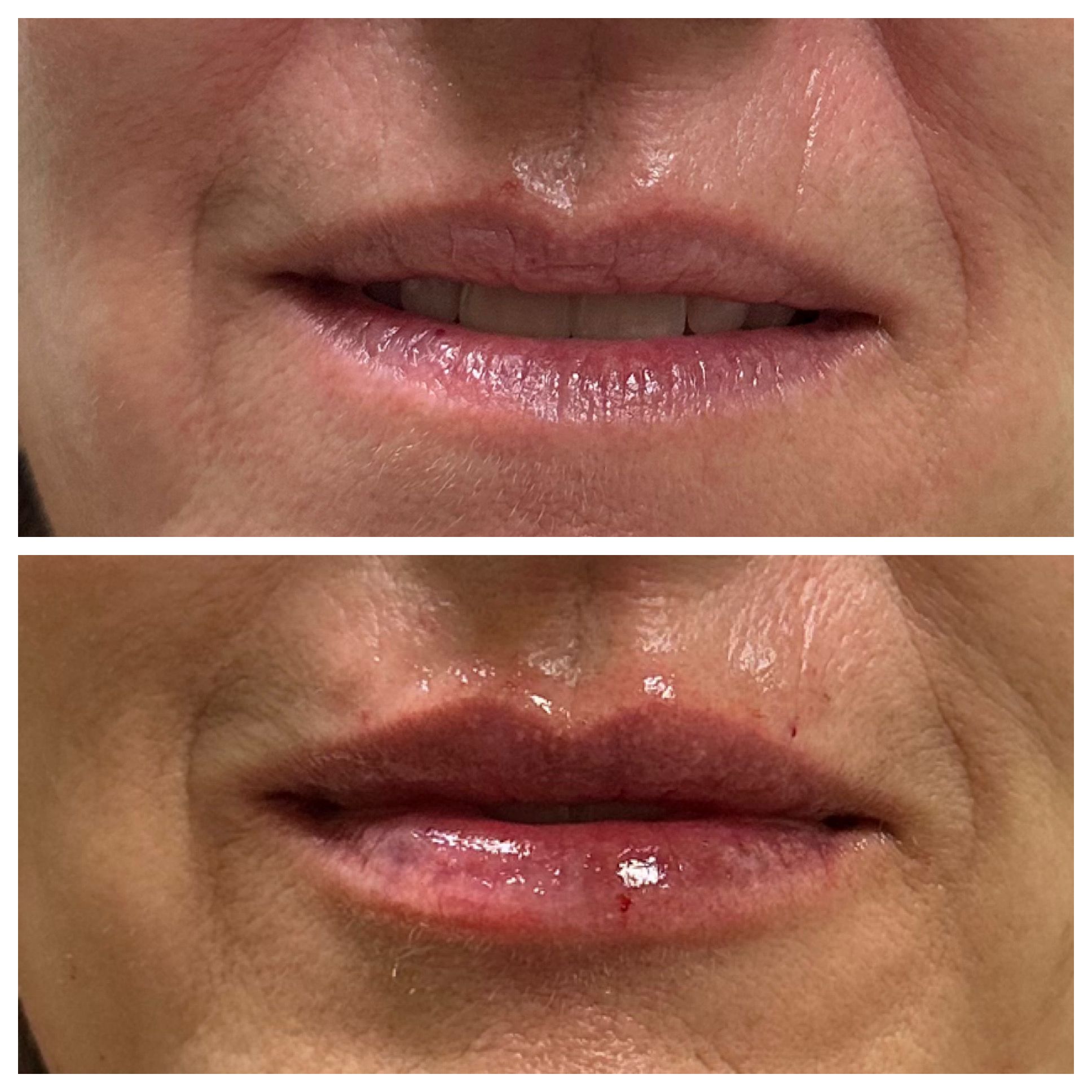Lip filler results