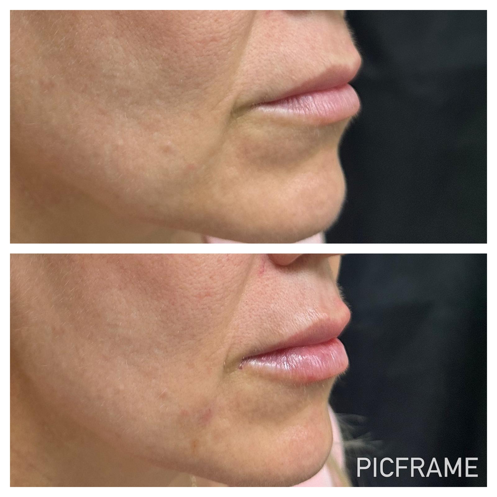 Lip filler results, side profile