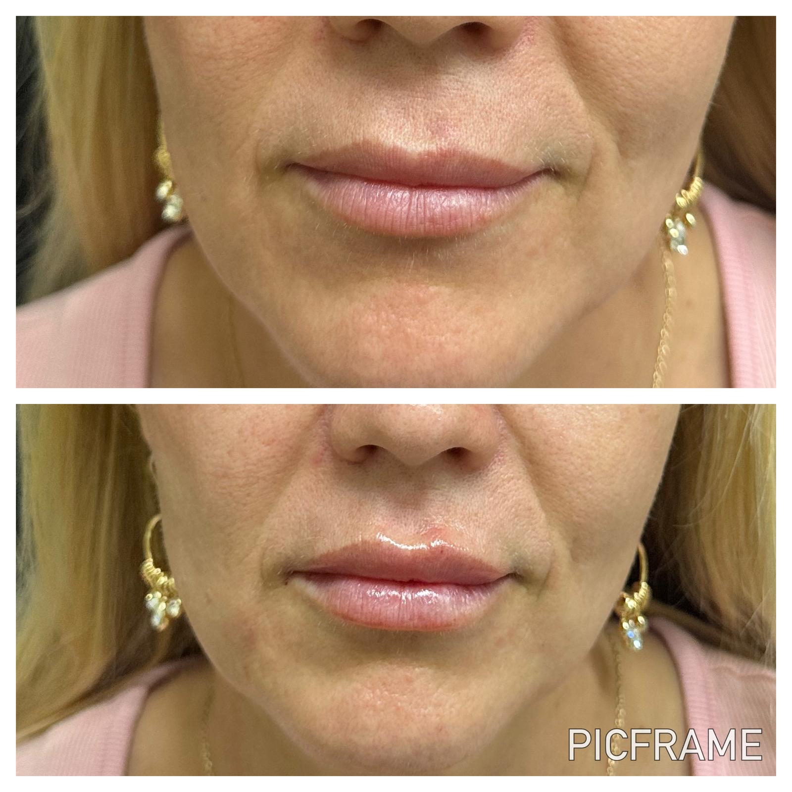 Lip filler touch-up, one year later (Revanesse Lips)