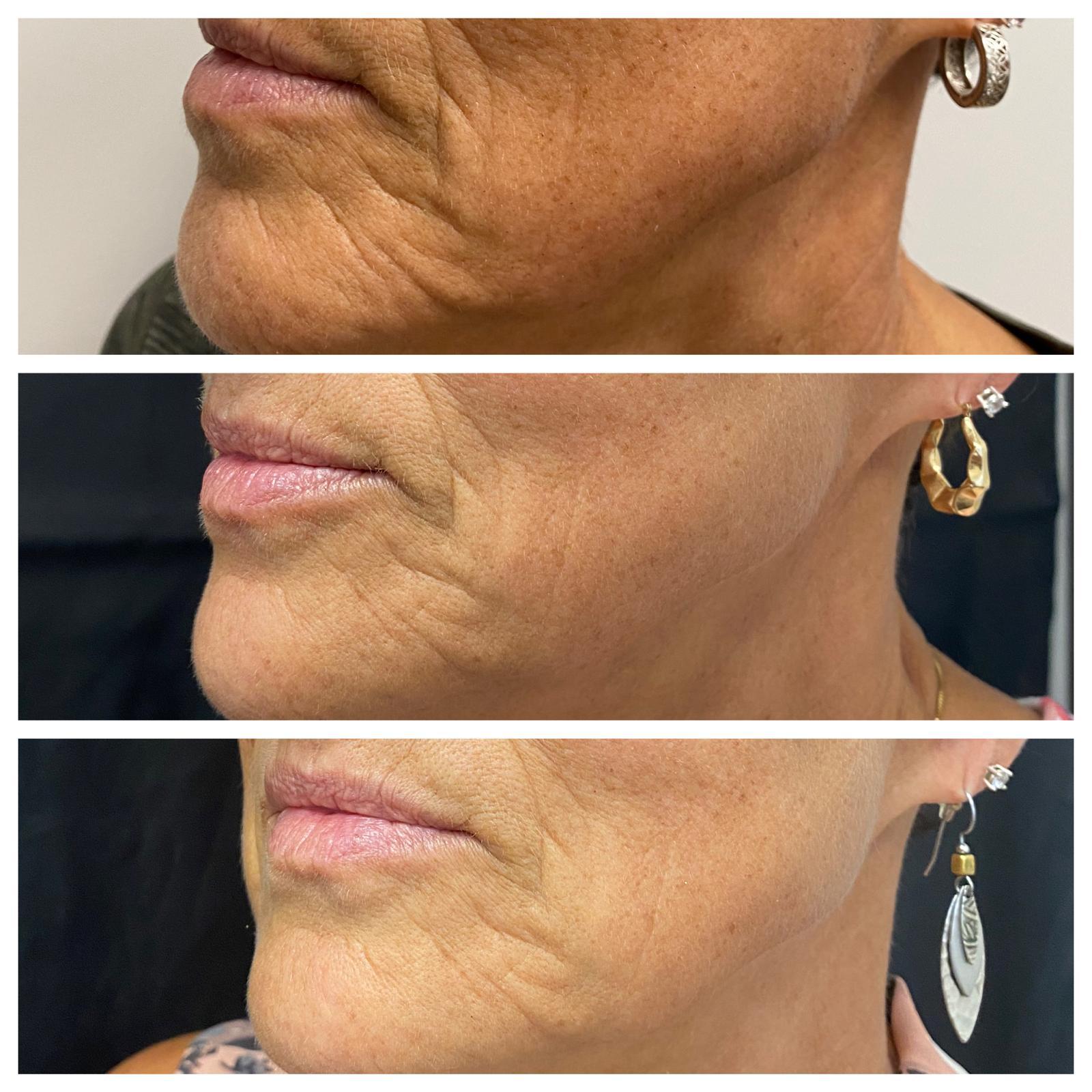 Lip and perioral treatment results