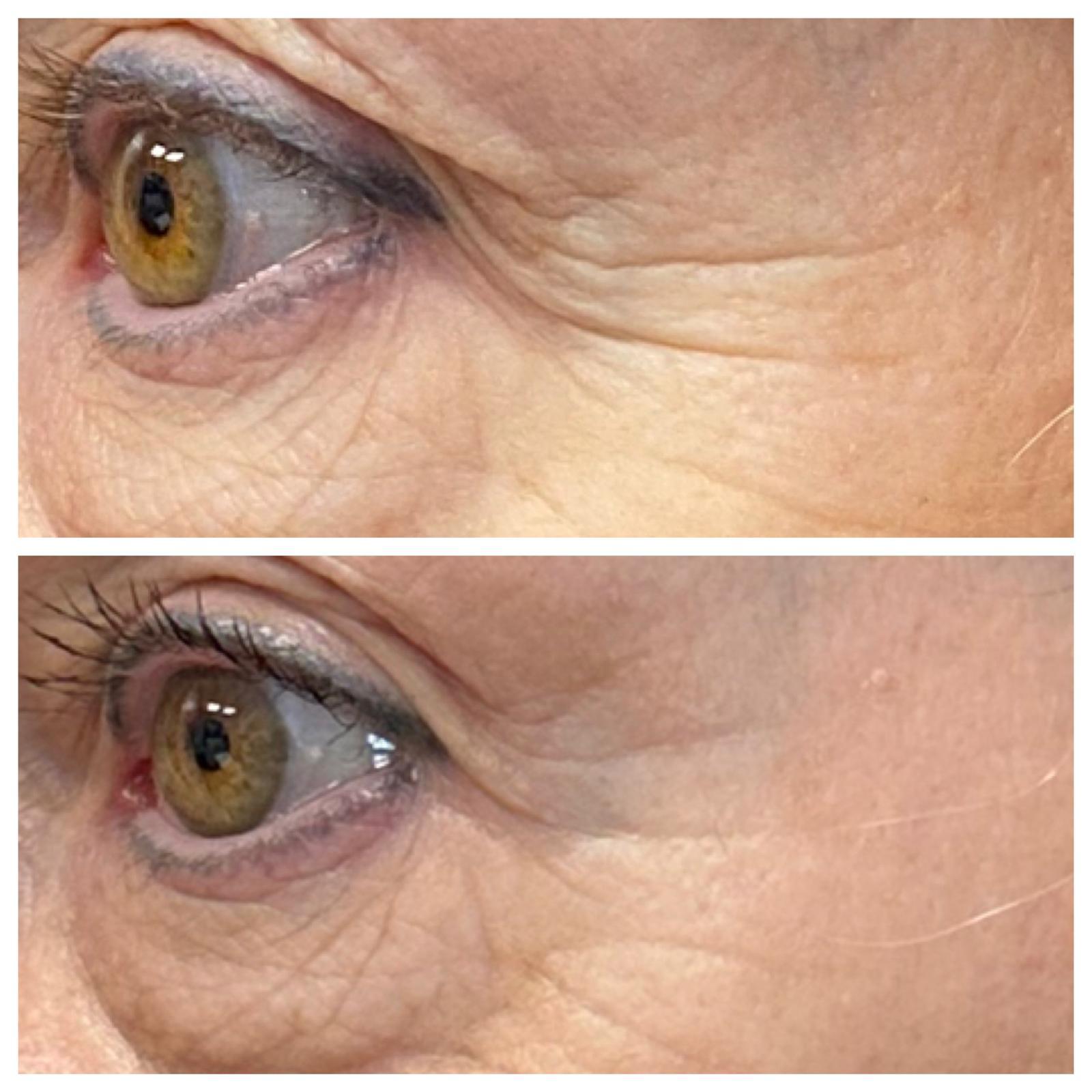 Crow's feet and under-eye smoothing results