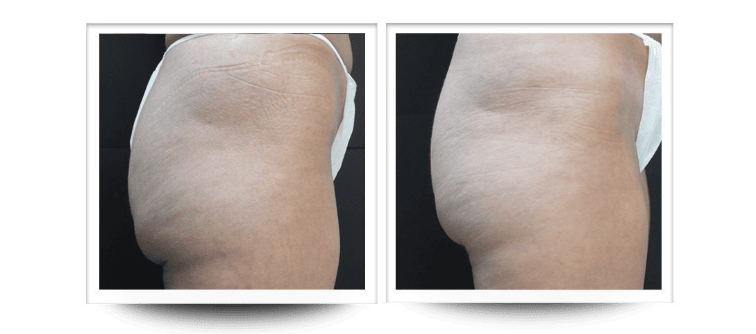 Accent prime butt cellulite before and after results