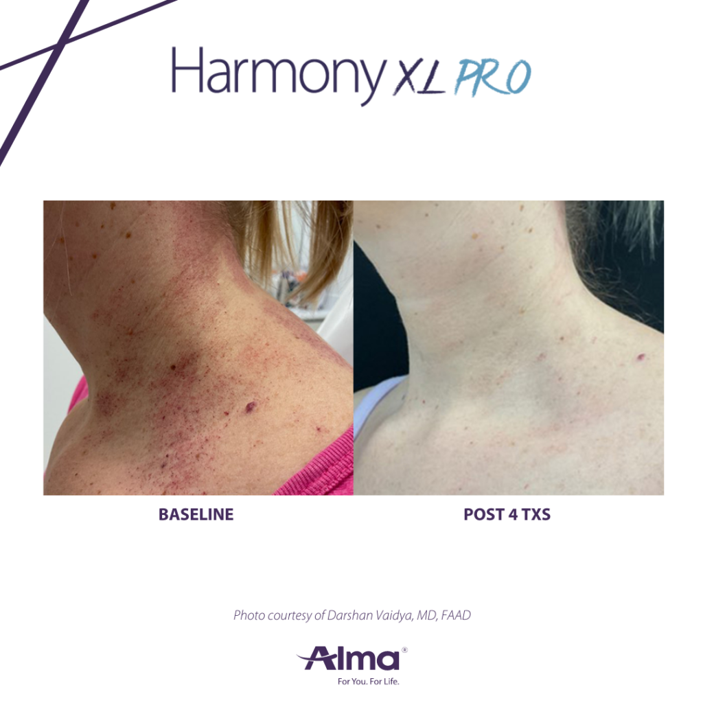 treating melasma, Harmony XL Pro, skin tone