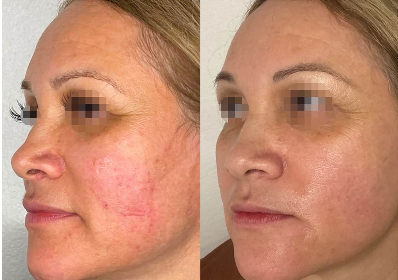 Harmony XP Pro acne treatment results