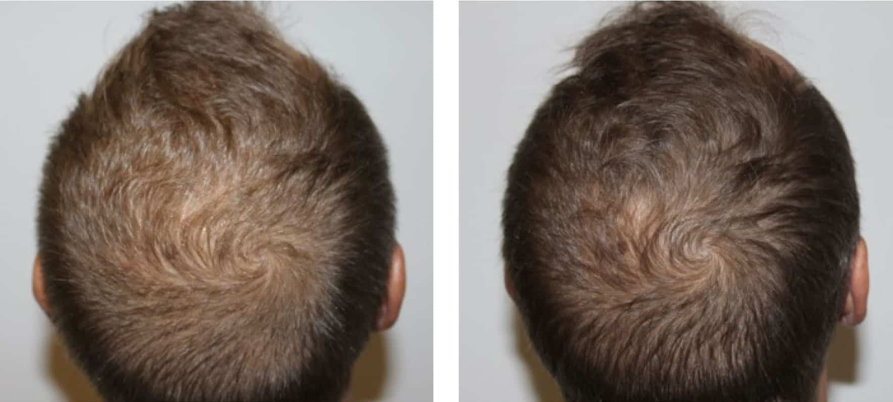 Keravive scalp treatment before and after