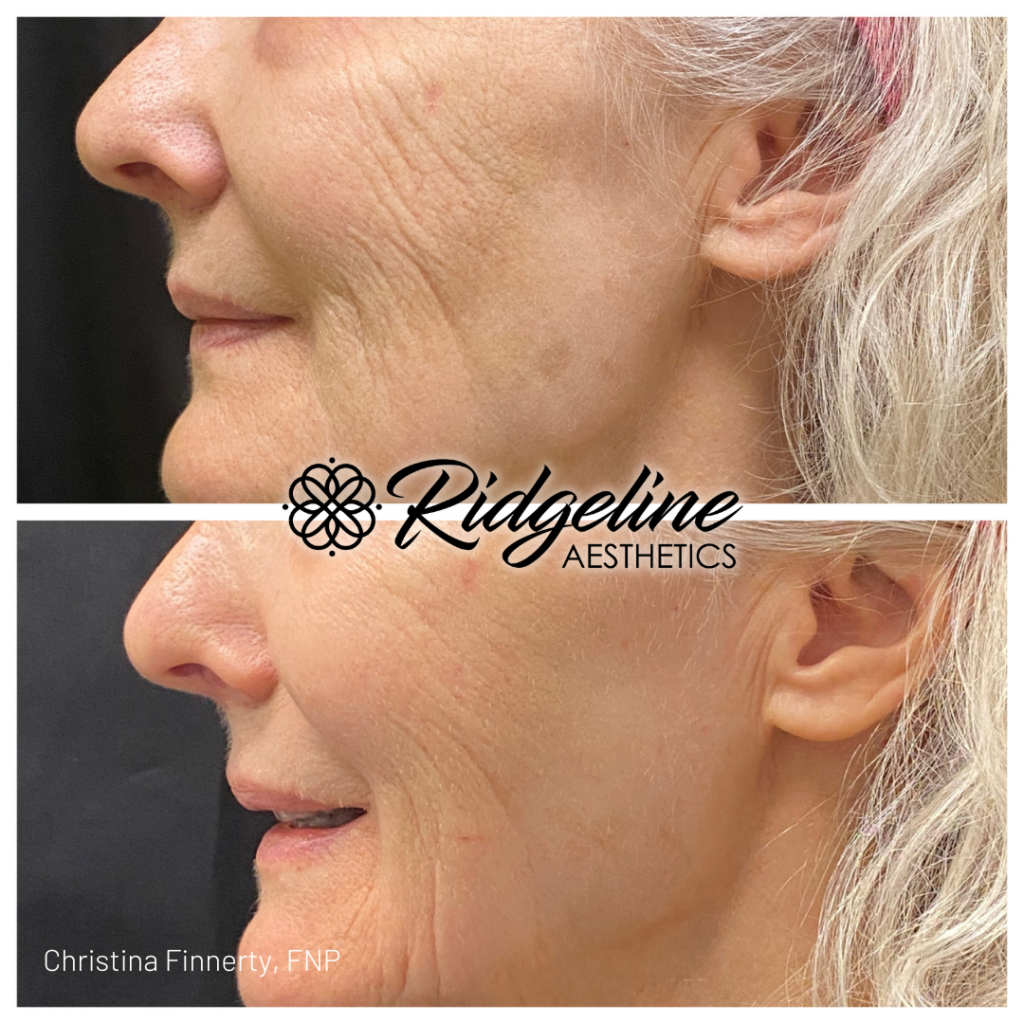 Opus Plasma treatment before and after results