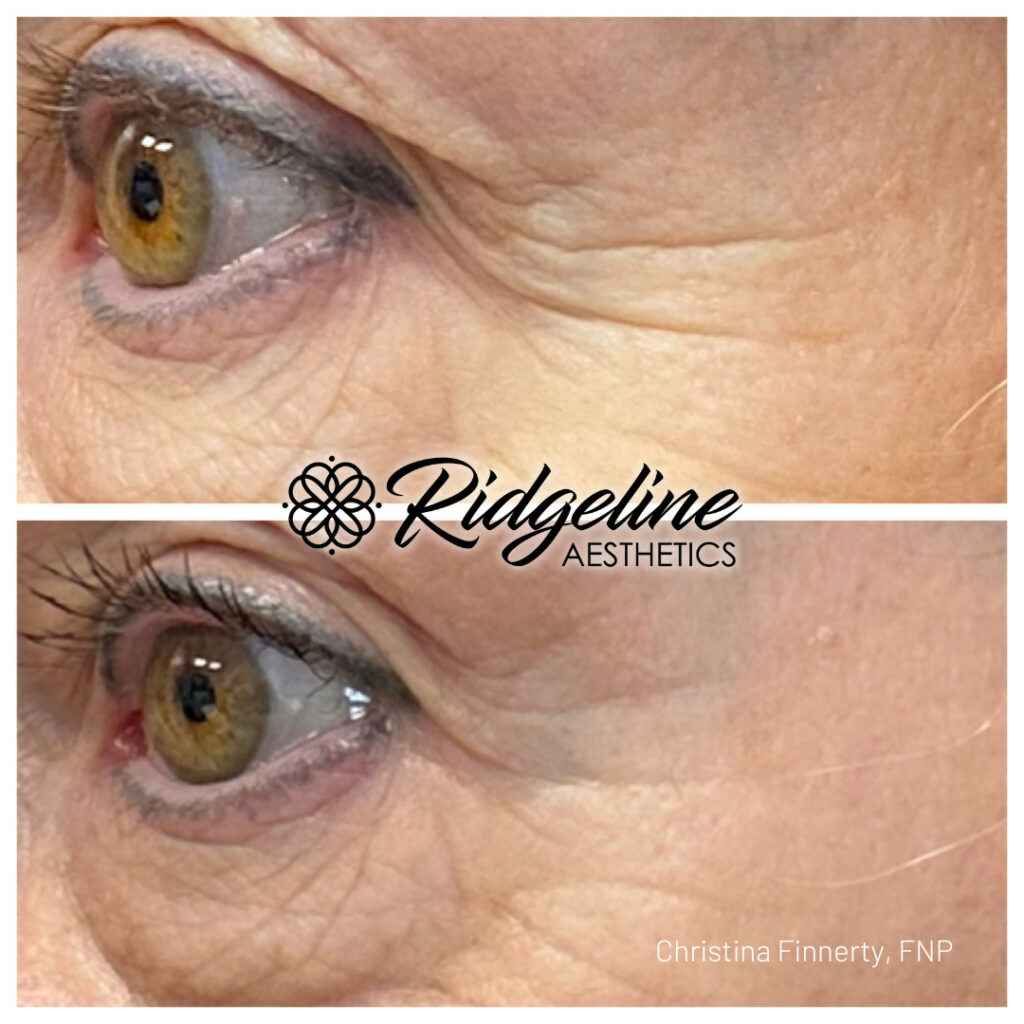 skin treatment, opus plasma skin tightening