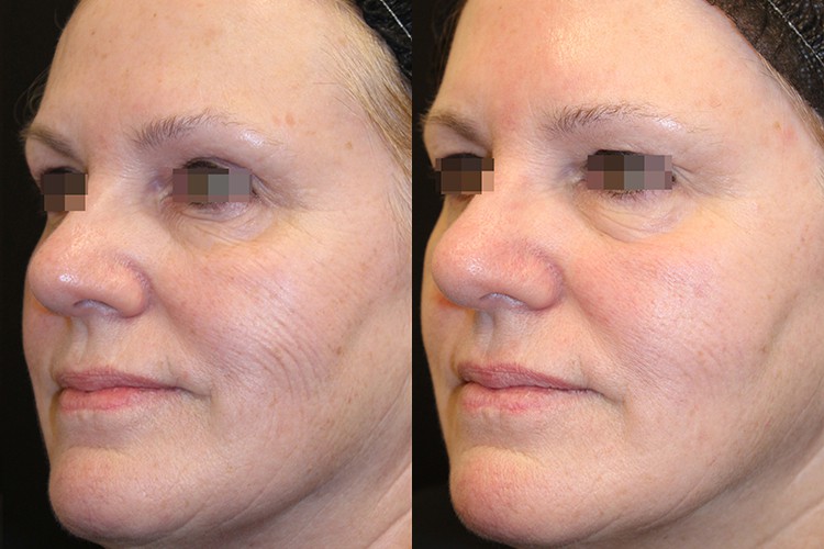 Woman seeing improvement in skin texture from laser treatment
