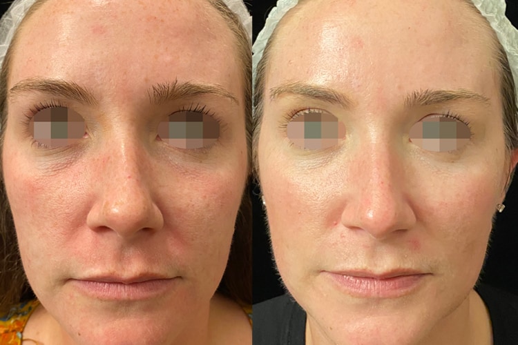Laser skin resurfacing before and after