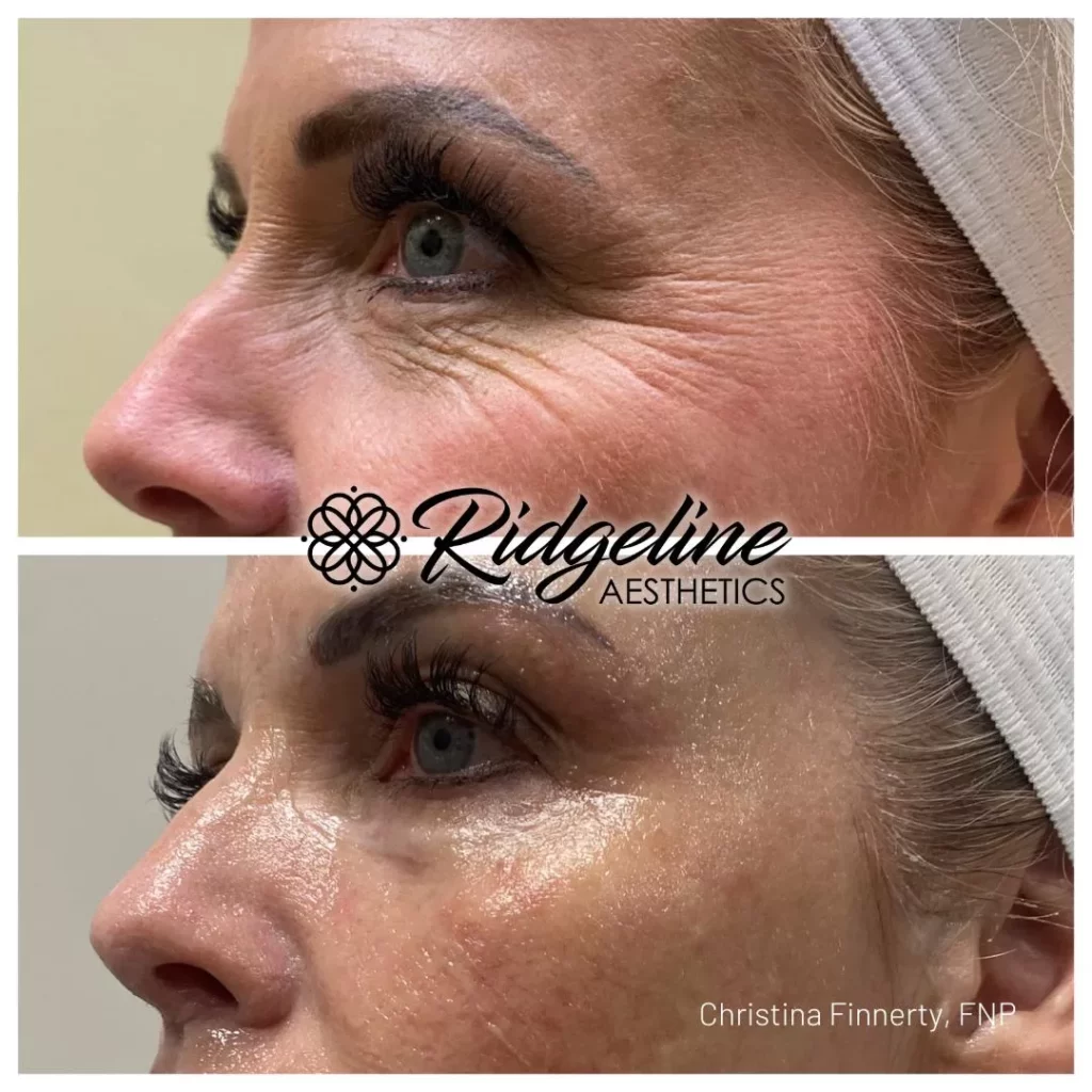 Opus Skin Tightening Before/After Photos