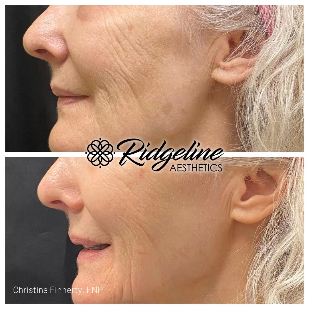 Opus Skin Tightening Before/After Photo