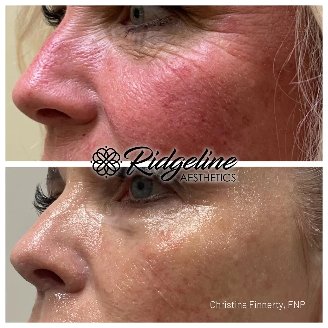 Opus Skin Tightening Before/After Photo