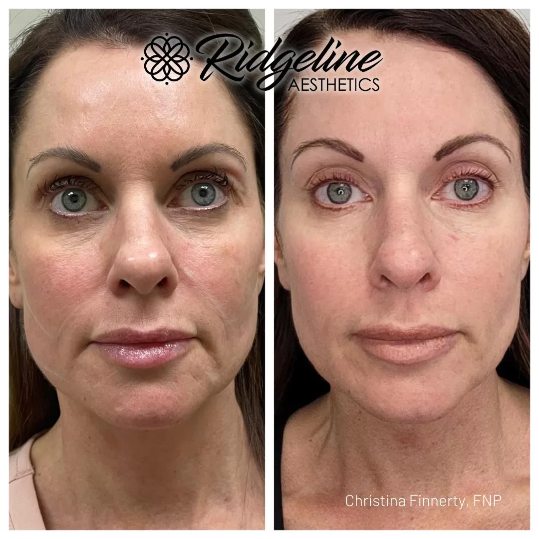 Opus Skin Tightening Before | After Photos