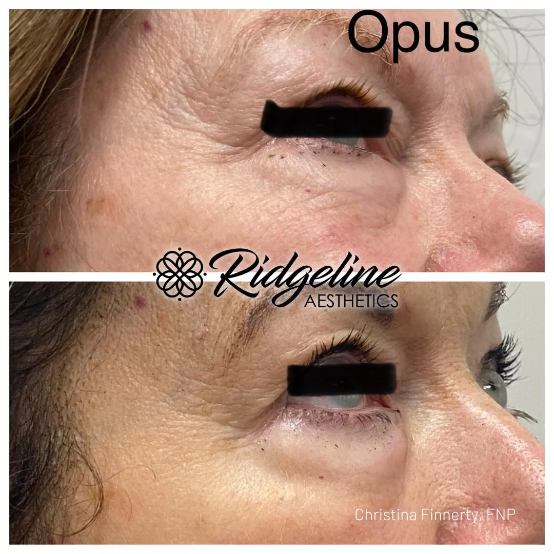 Opus Skin Tightening Before/After Photos