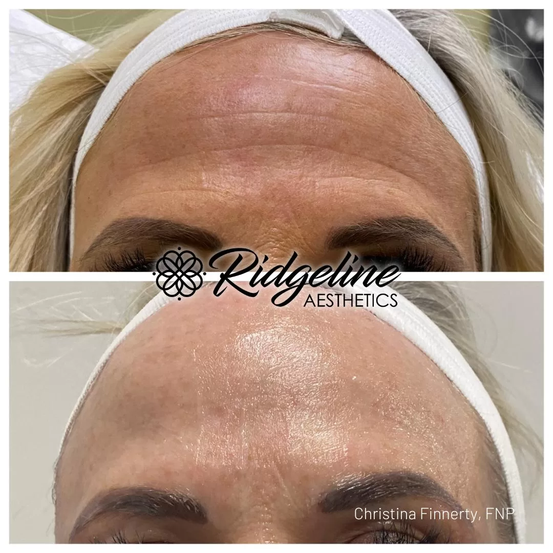 Opus Skin Tightening Before/After Photos 7