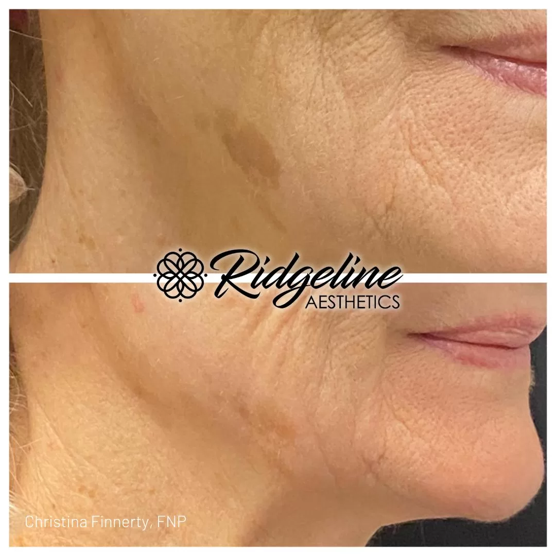 Opus Skin Tightening Before/After Photos