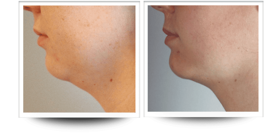 Accent Prime body sculpting neck results
