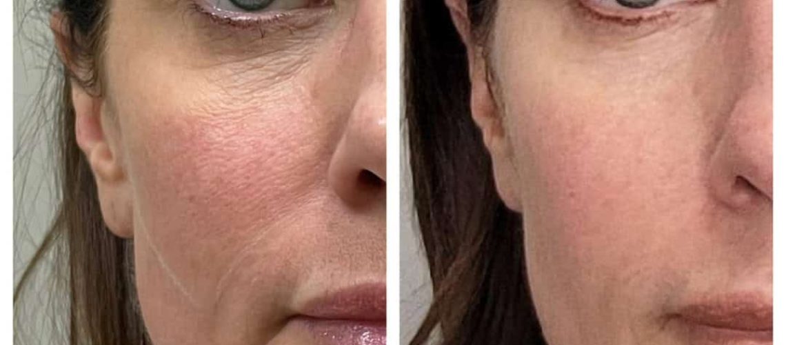 loose skin, plasma skin tightening