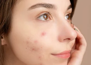 laser treatment for acne scars